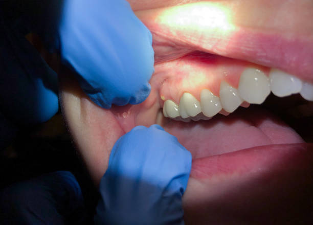 Best Emergency Dental Care for Abscessed Tooth in Ttapoisett Center, MA